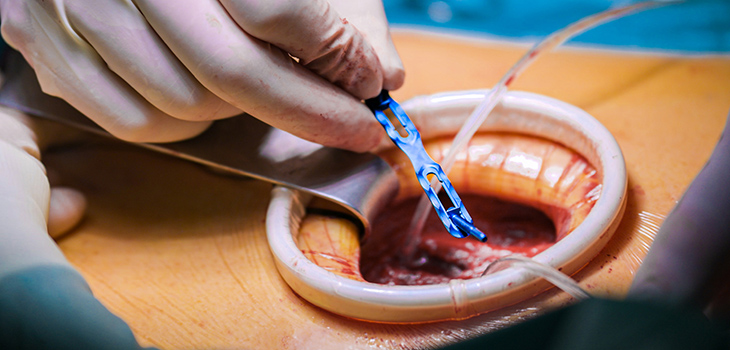 ‘Rib Fix Advantage’ implant system
